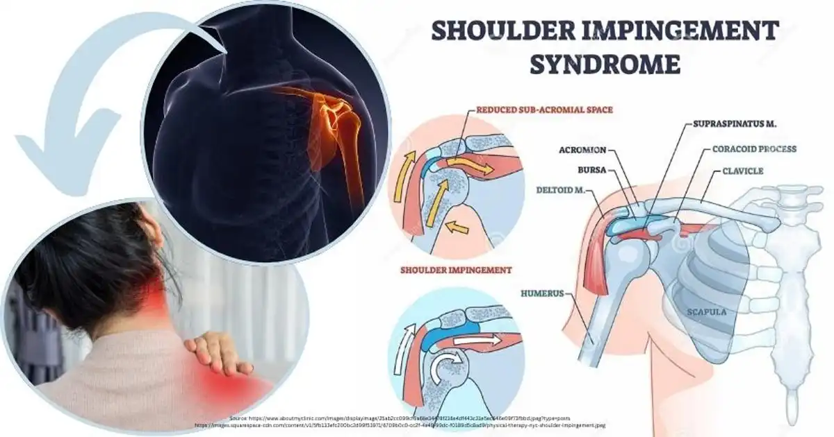 Shoulder Impingement